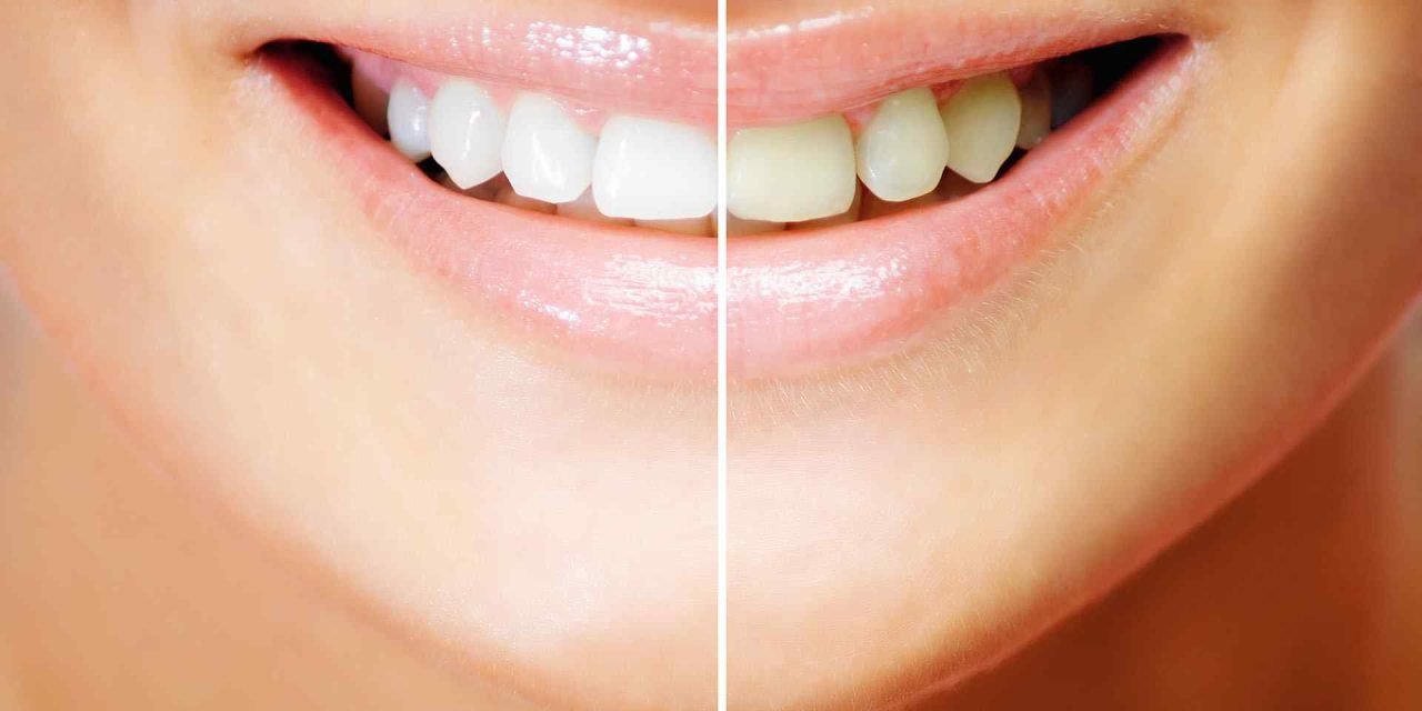 Teeth Whitening: The Best Ways to Keep Your Teeth Healthy and White #TeethWhitening