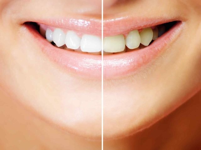 Teeth Whitening: The Best Ways to Keep Your Teeth Healthy and White #TeethWhitening