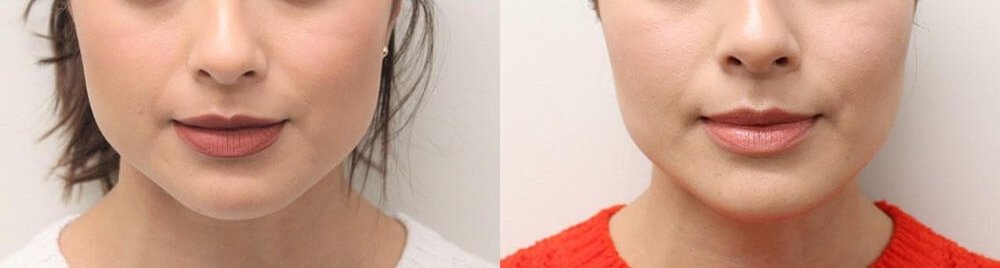 https://dentistmillvalley.com/wp-content/uploads/2023/12/botox-masseter-before-after.jpg