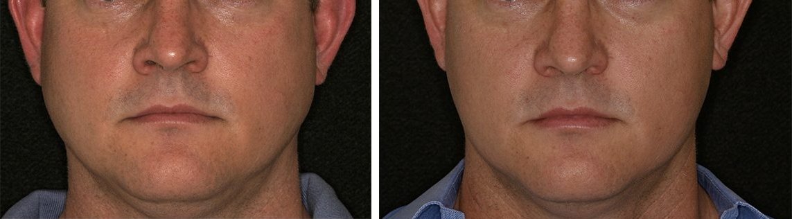 https://dentistmillvalley.com/wp-content/uploads/2023/12/slimming-before-after.jpg