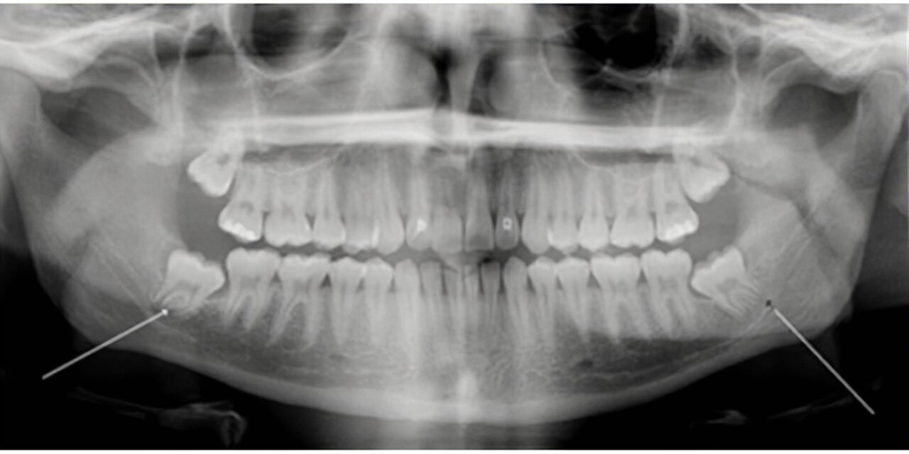 The Myth of Wisdom Teeth and Crowding: What You Need to Know
