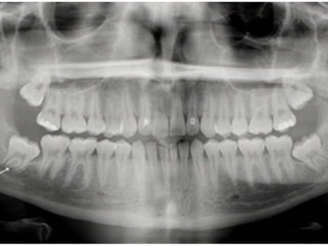The Myth of Wisdom Teeth and Crowding: What You Need to Know