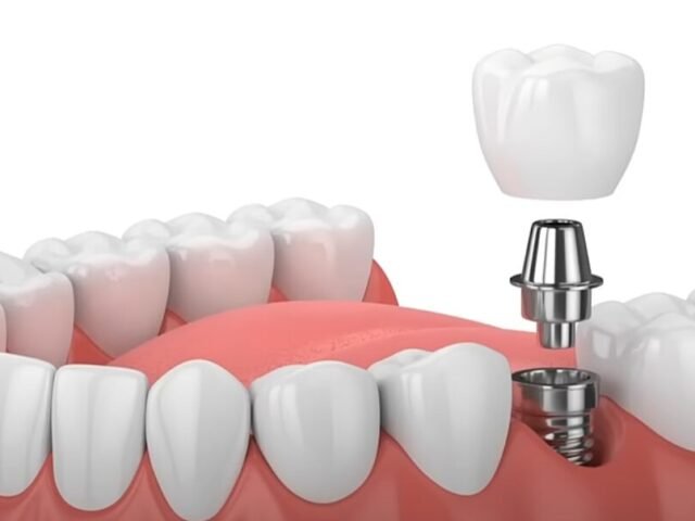 Pros and Cons of Dental Implants: What You Need to Know #DentalImplants #Dr.Yankie