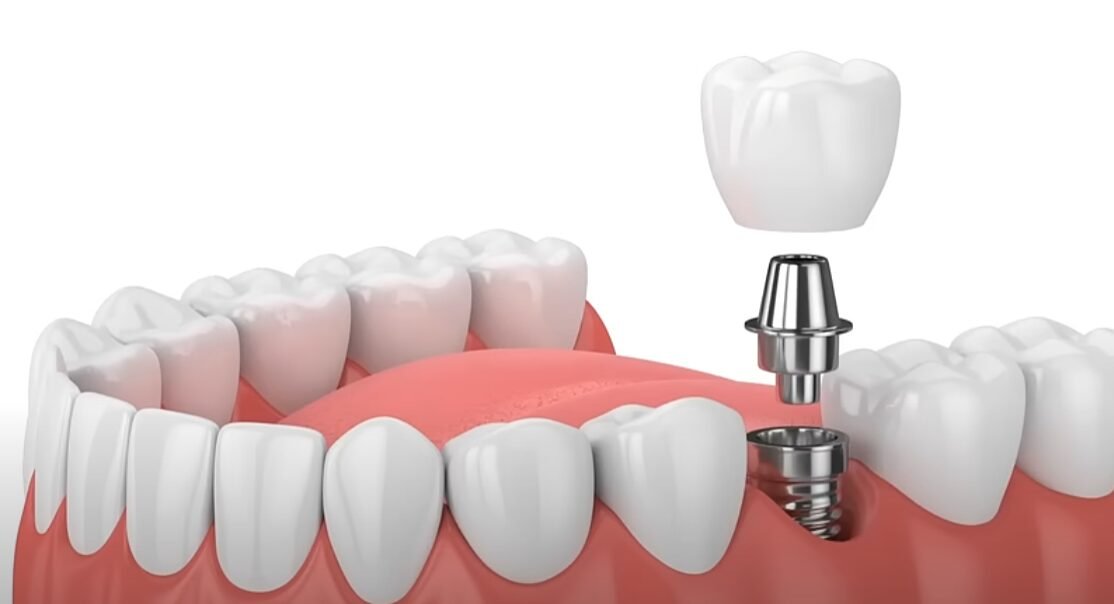 Pros and Cons of Dental Implants: What You Need to Know #DentalImplants #Dr.Yankie