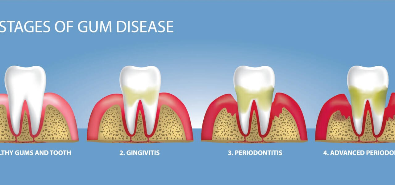 How A Dentist Treats Gum Disease: A Comprehensive Guide
