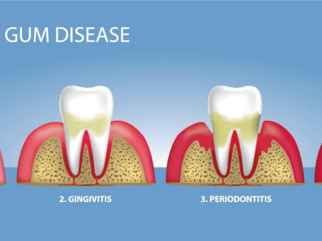How A Dentist Treats Gum Disease: A Comprehensive Guide